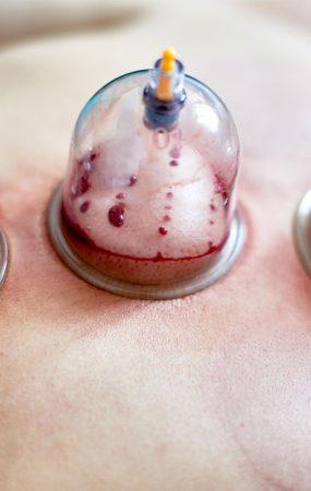 HijamaSunnahBloodCupping